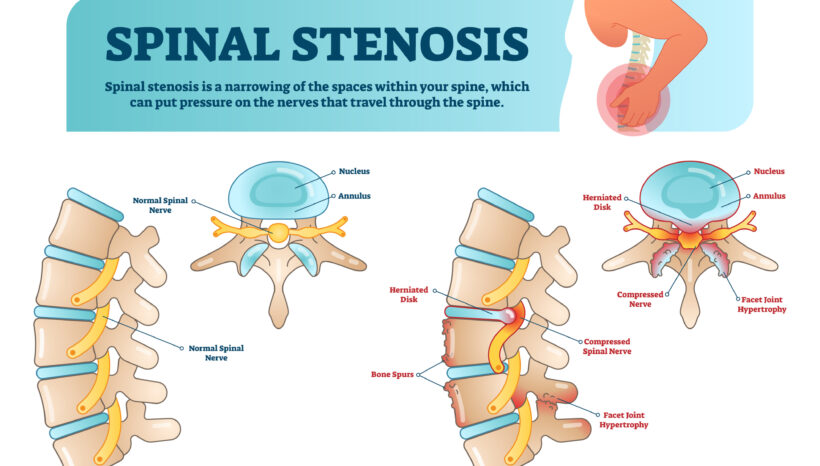 Pain Relief Exercises for Spinal Stenosis